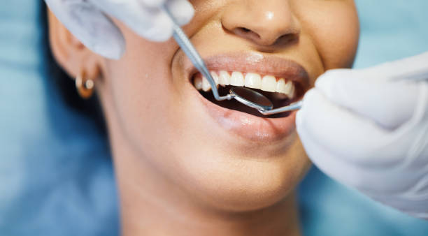 Best Knocked-Out Tooth (Avulsed Tooth) Treatment in Baidland, PA